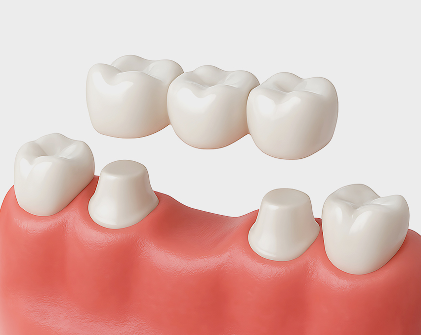 Image of Dental Bridge | Dental Bridge in Cary NC