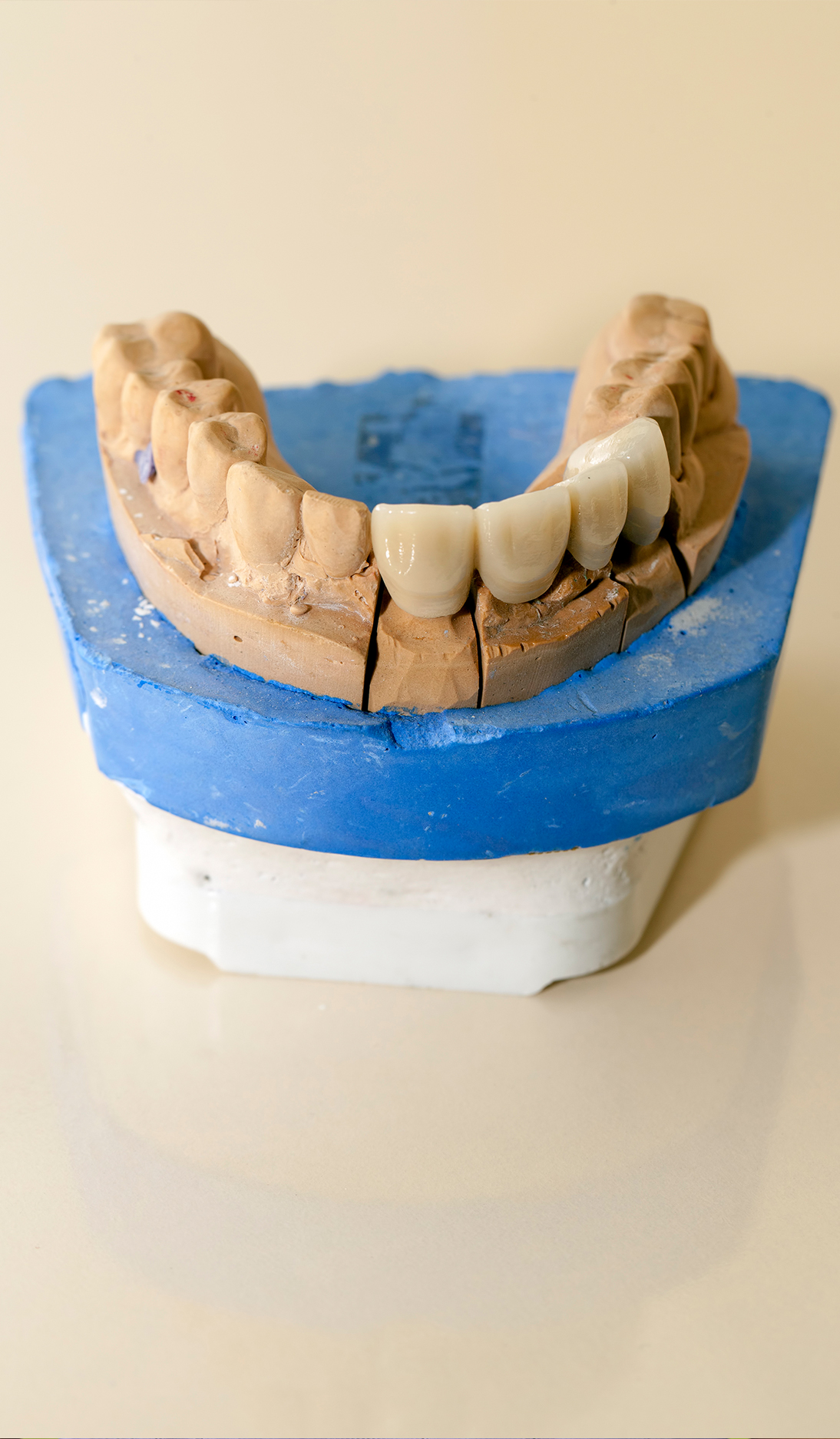 Image of a dental bridge on a dental model | Dental Bridges Cary NC